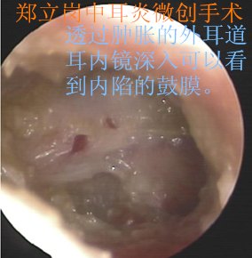 鄭立崗膽脂瘤中耳炎術後復發微創手術817廣東吳