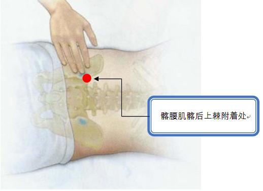 髂腰肌髂后上棘痛点.jpg