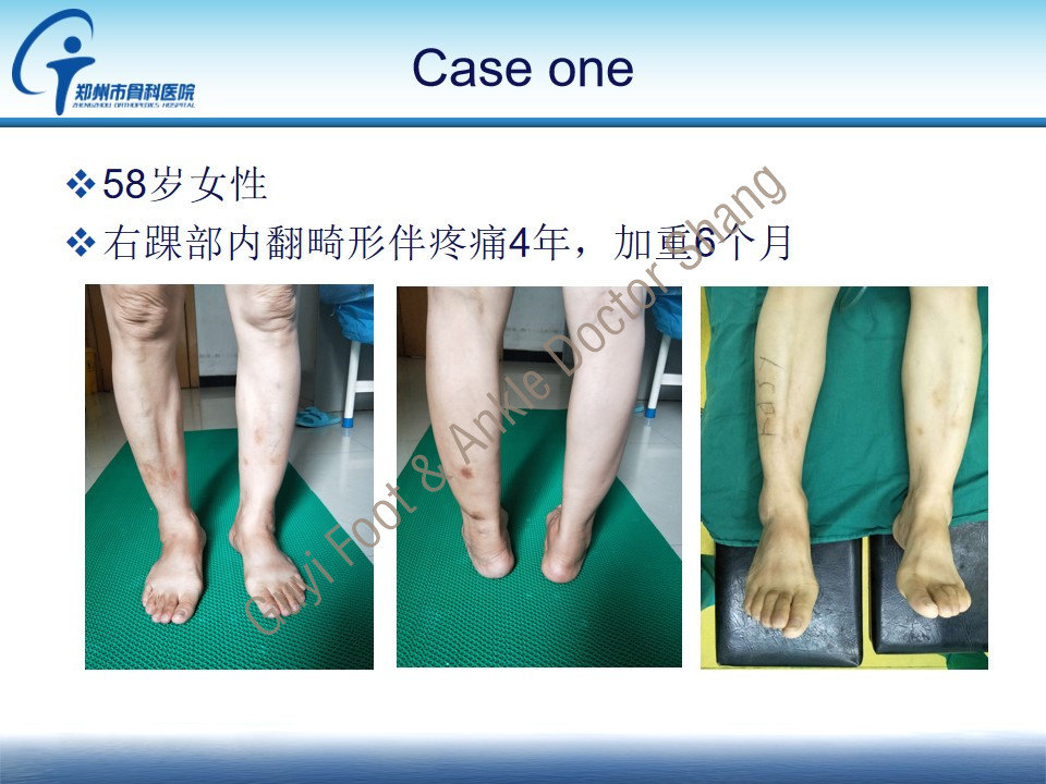 踝上截骨治疗内翻型踝关节炎 - 好大夫在线