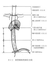 食管癌的病变分段