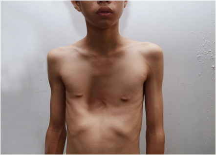 漏斗胸治疗方法 漏斗胸治疗方法