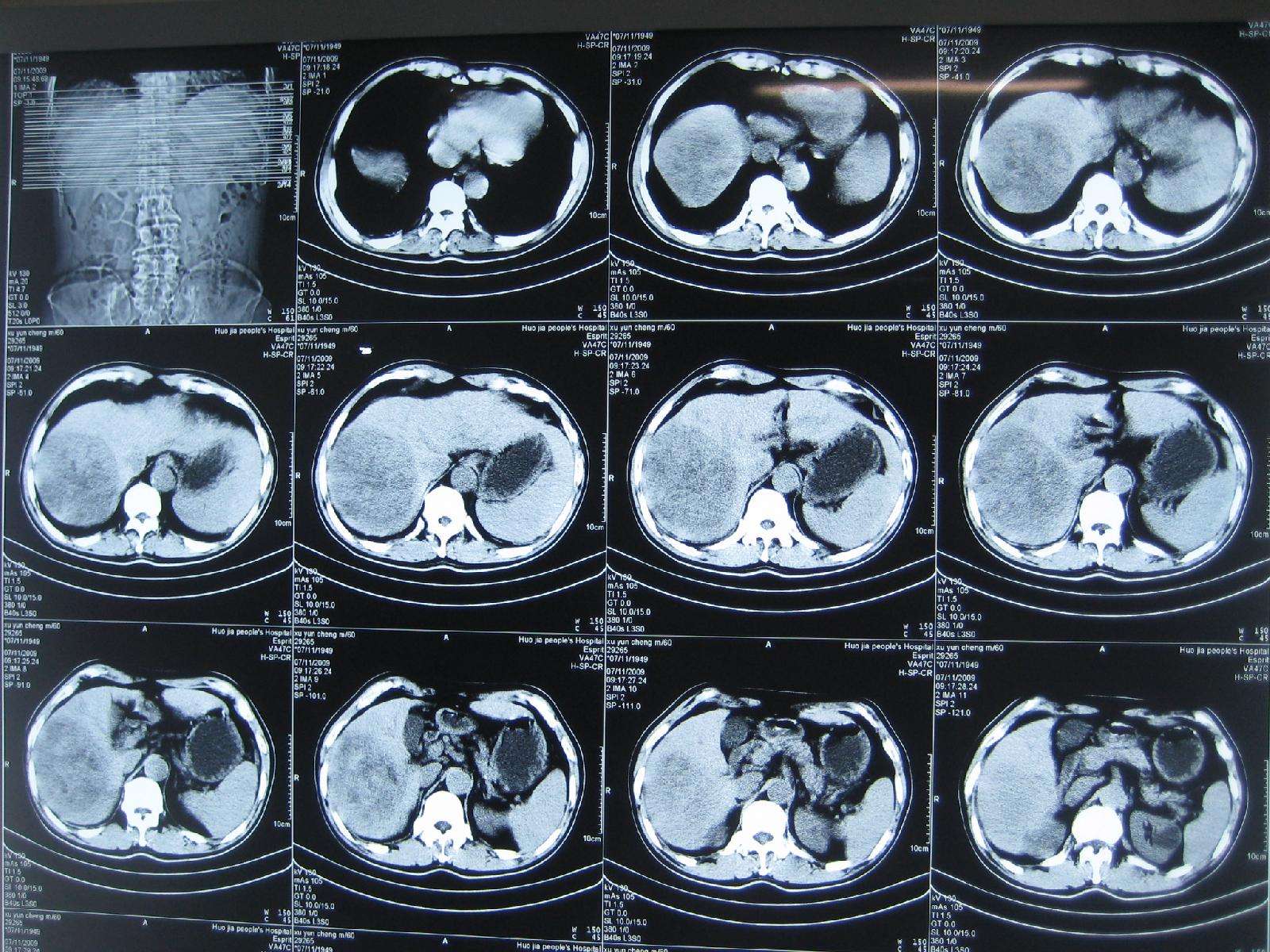 肝癌晚期ct图片图片