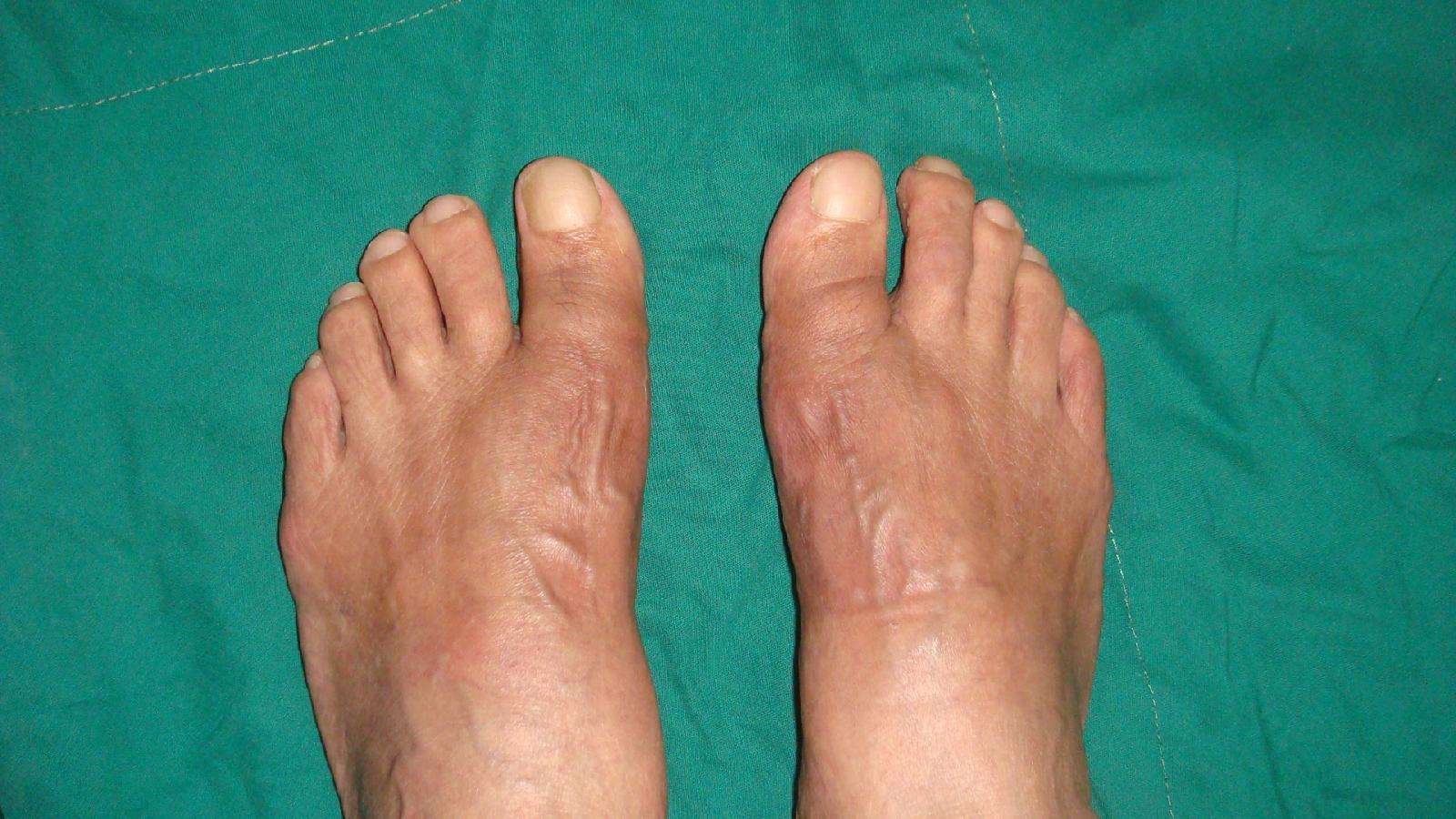 拇外翻术前术后对比照片1