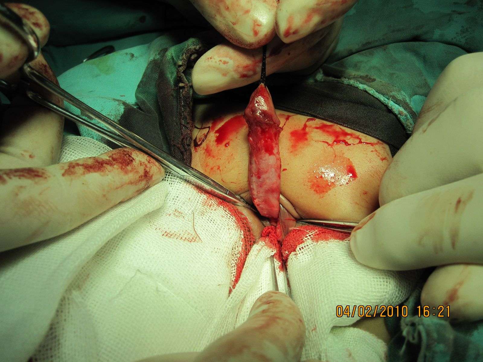 小儿尿道下裂手术图片