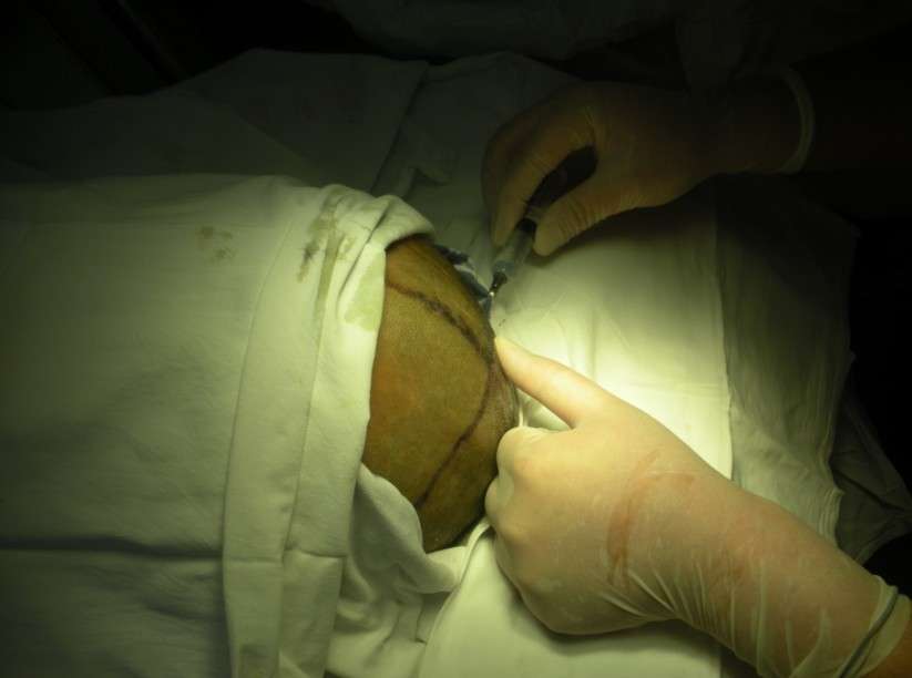 颅骨牵引术图解 - 好大夫在线