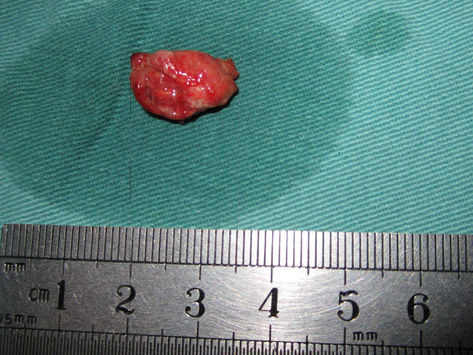 nasal dermal sinuses and cysts.