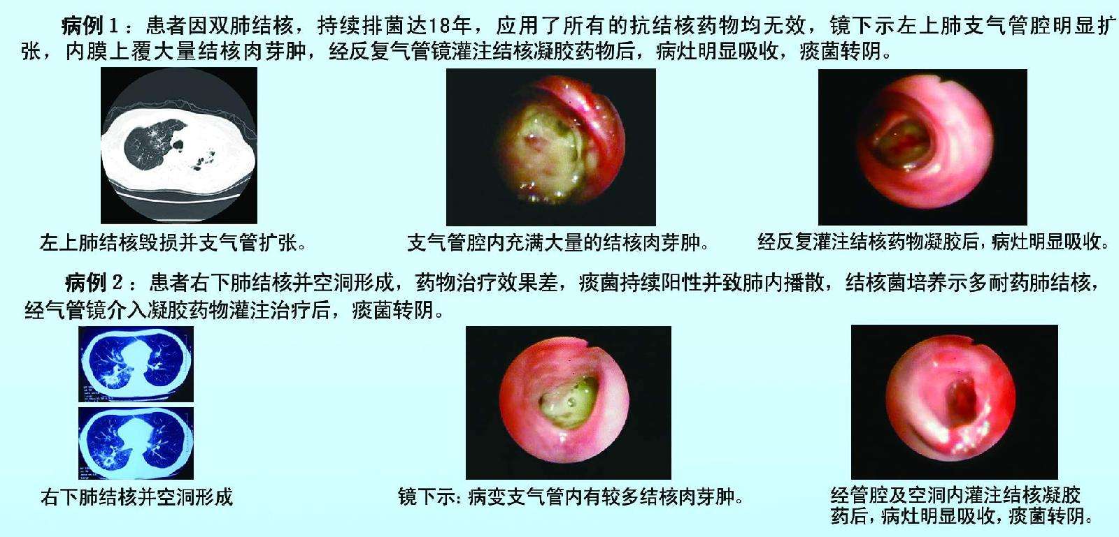 氣管鏡介入灌注藥物凝膠治療耐藥空洞支氣管肺結核