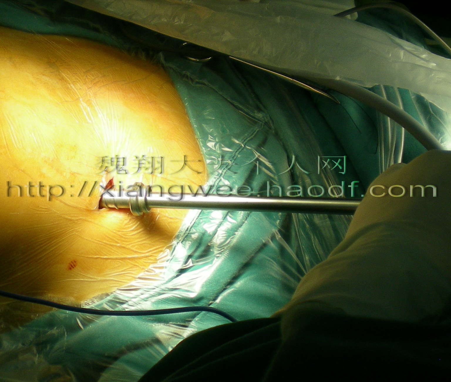 与以往开胸,锯开胸骨不同,微创的房缺修补术,只