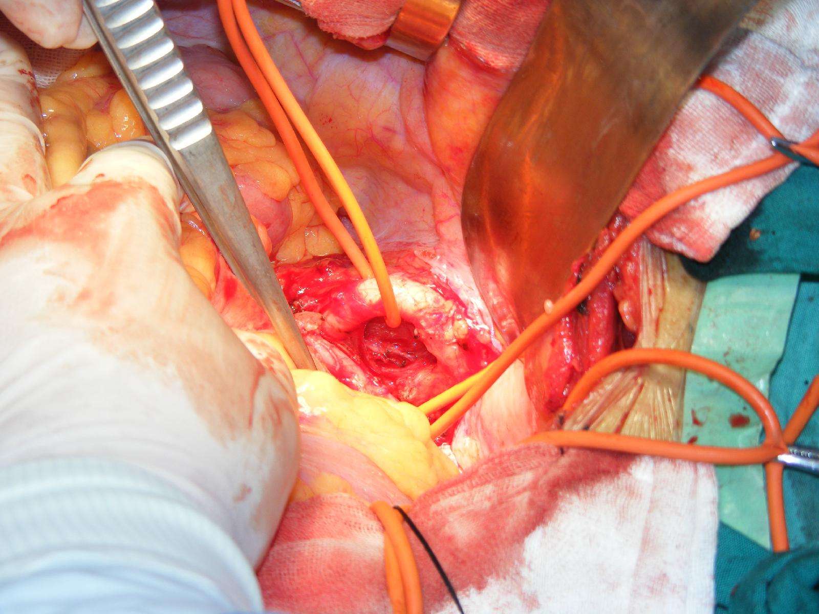 腹主动脉瘤手术中照片 - 好大夫在线