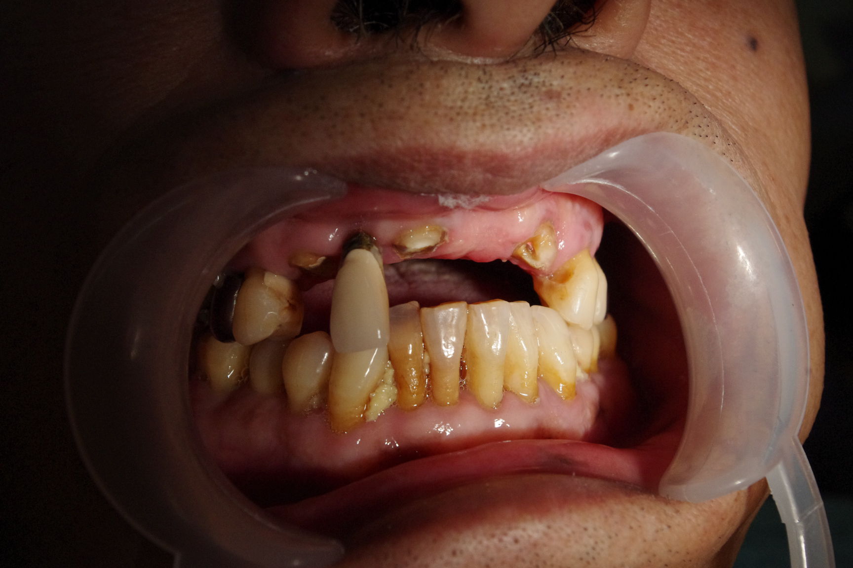 前牙美容修复病例1(牙冠修复法1例) 