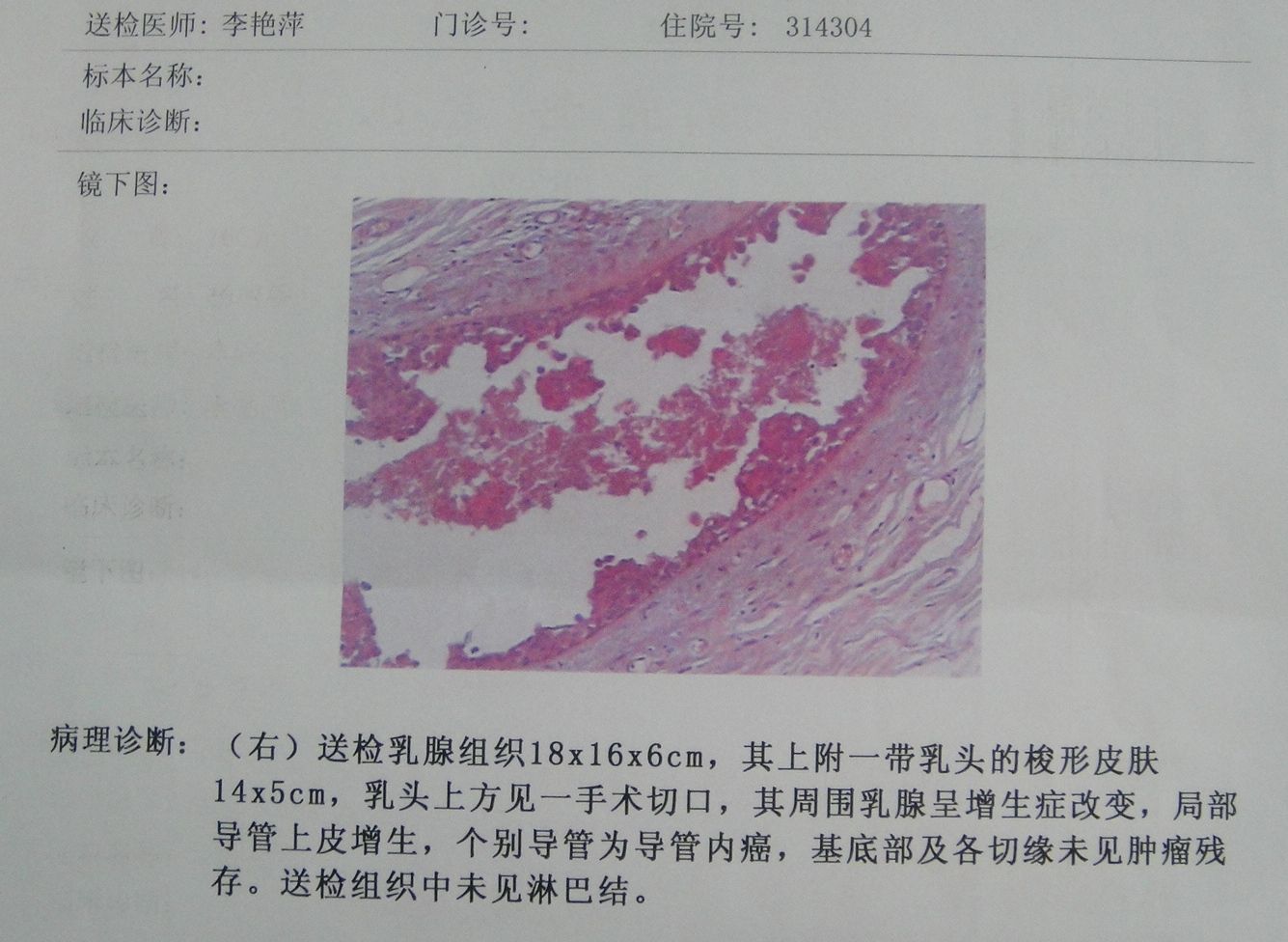 乳腺內異常鈣化灶導絲定位活檢