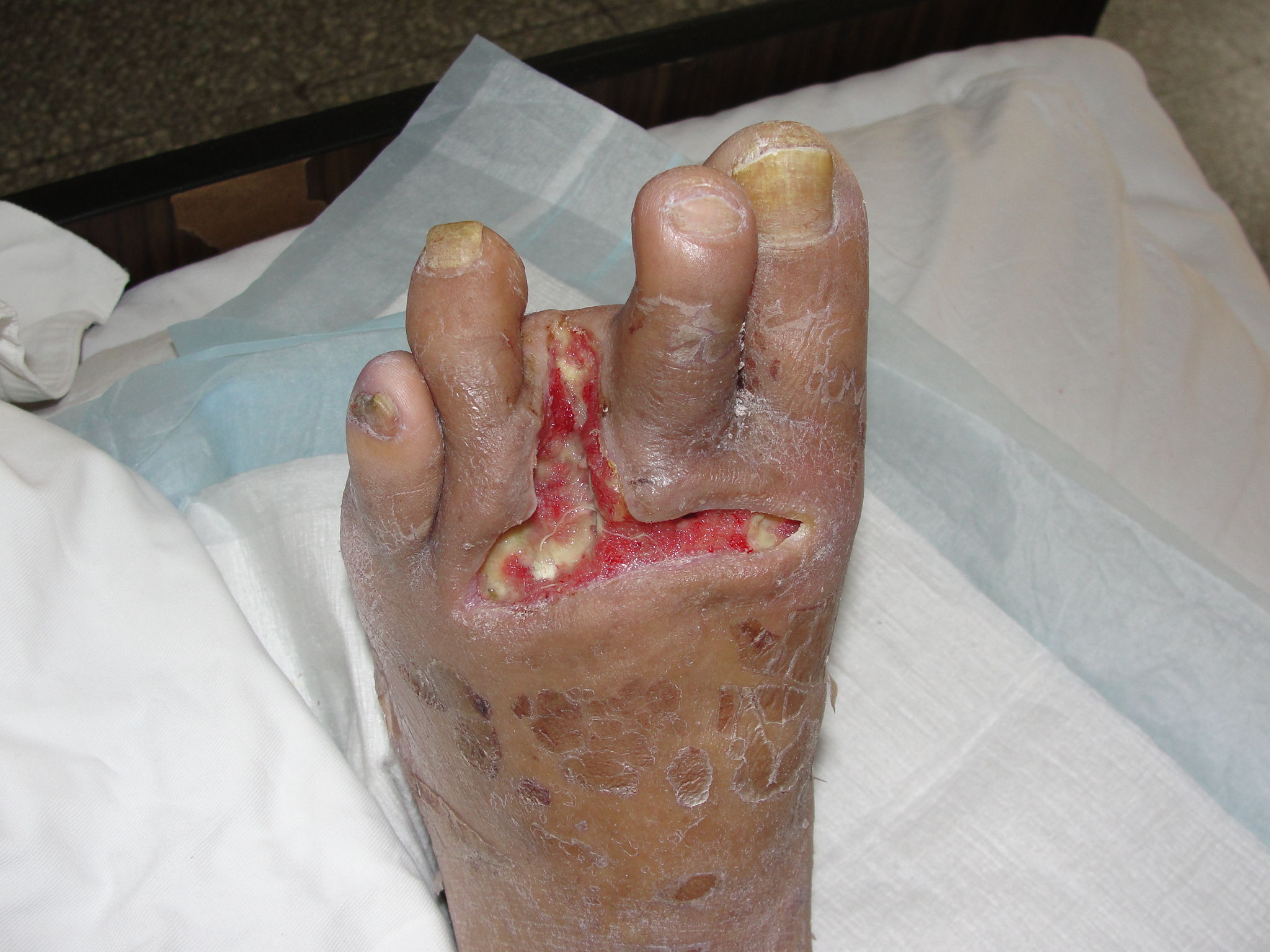 三部曲疗法治疗感染性糖尿病足 - 好大夫在线