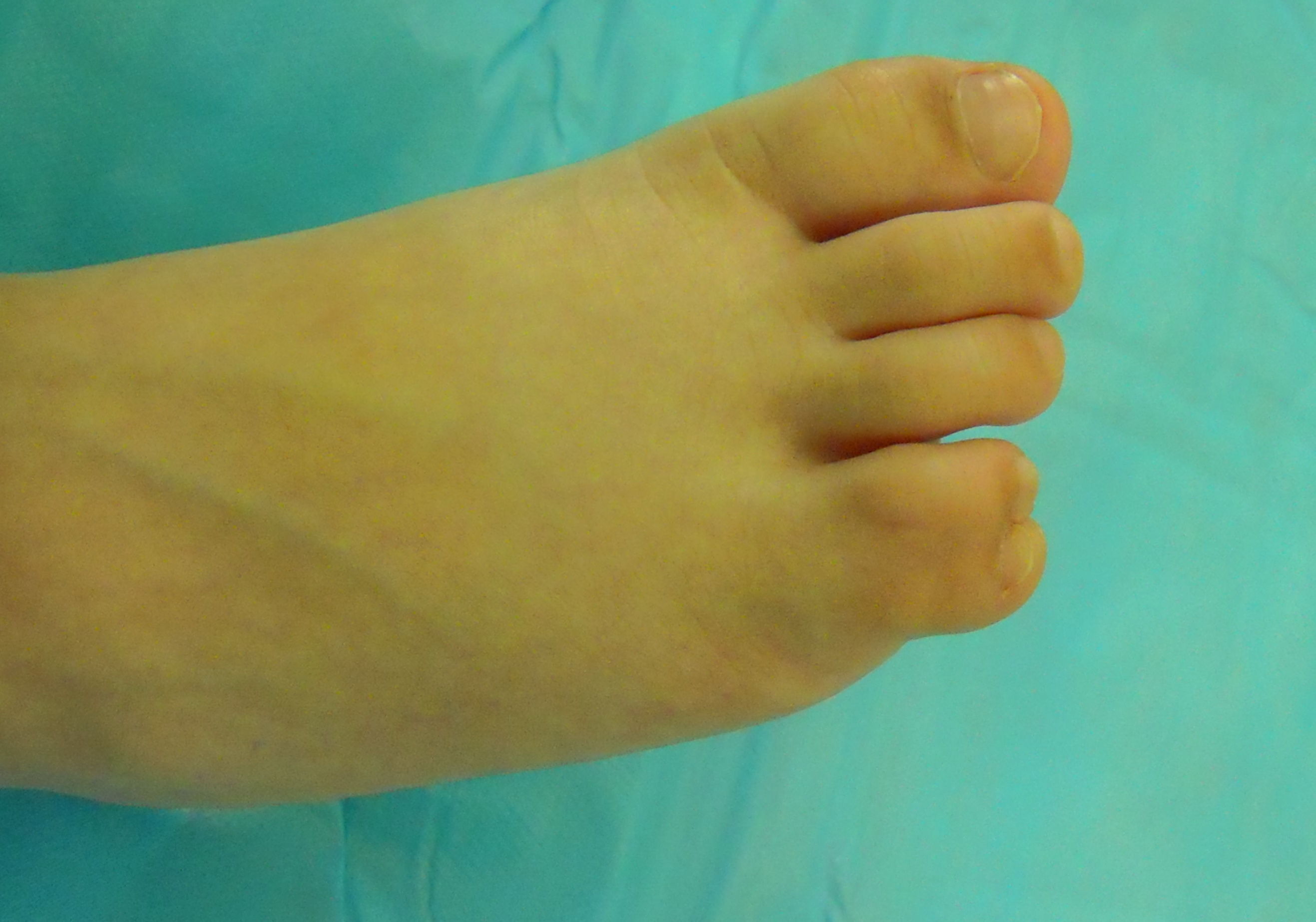 足趾畸形图片