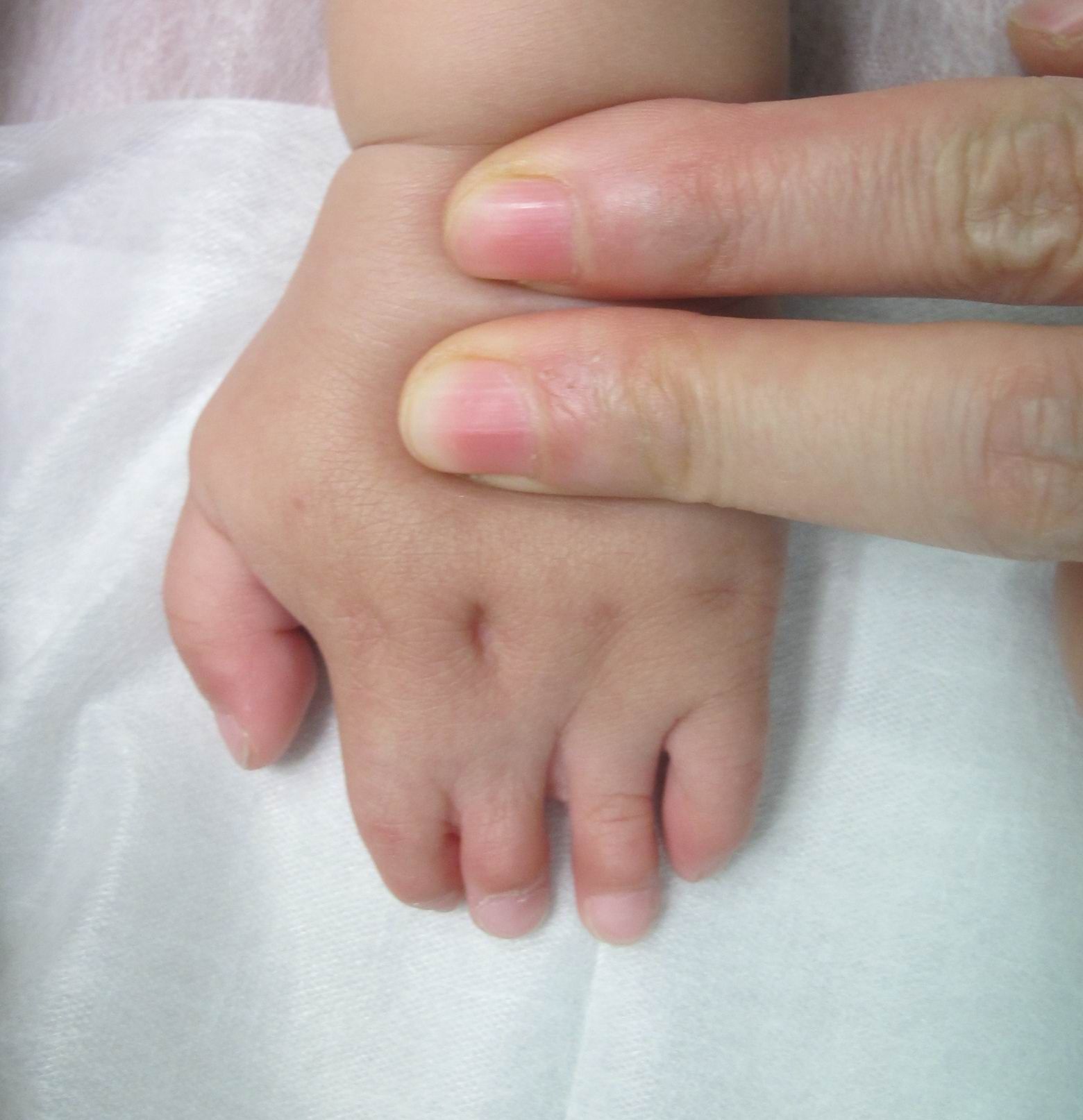 短指并指(波兰综合症):一次手术全部分离多个手指的并连_先天性并指多