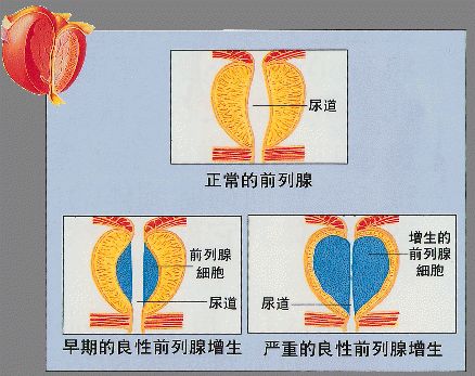 前列腺增生科普知识_前列腺增生_疾病介绍_介绍 - 好大夫在线