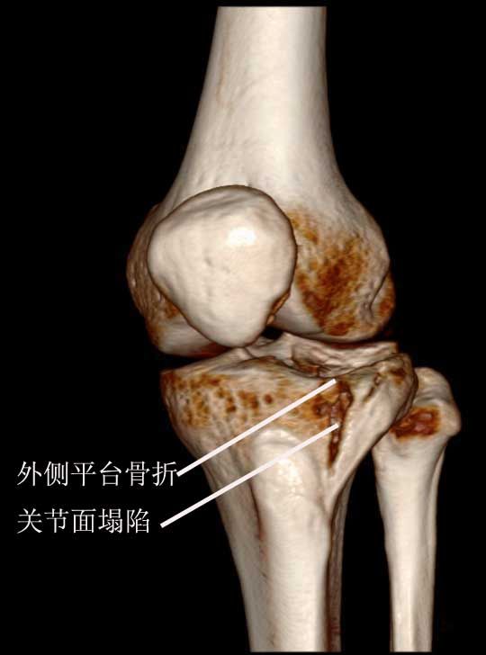 三维ct重建显示平台骨折,关节面塌陷病例3:刘某男32岁胫骨平台骨折(图