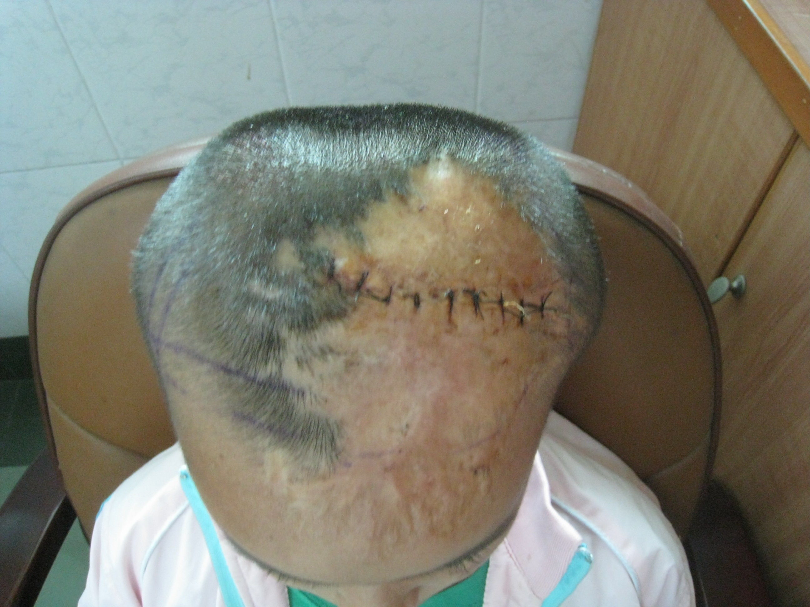 疤痕性秃发的(皮肤扩张器)治疗 - 好大夫在线