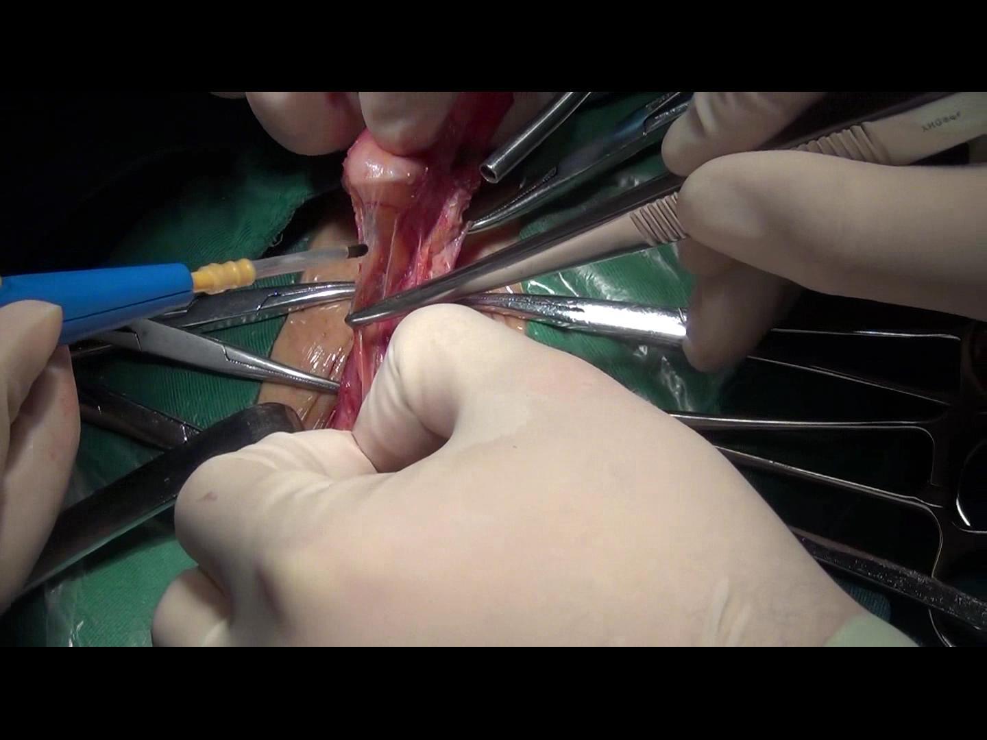 腹股沟疝的手术治疗(uhs) - 好大夫在线