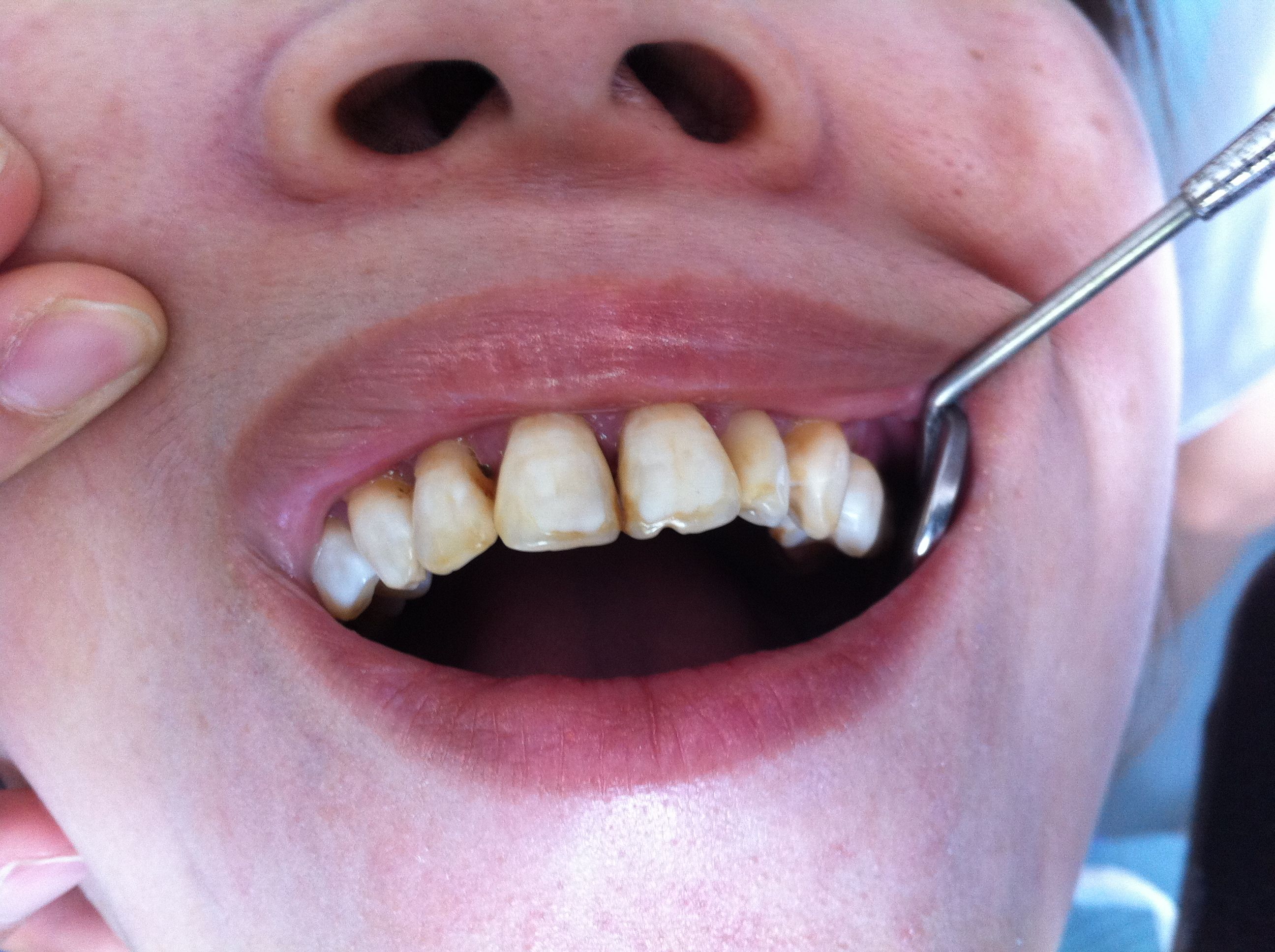 前牙瓷贴面美容修复一例 - 好大夫在线