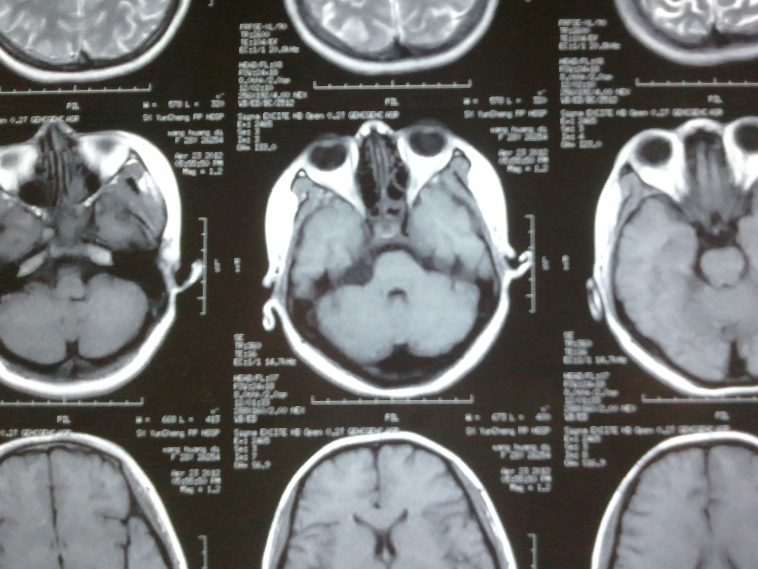 西京医院颅内胆脂瘤治疗实例图组