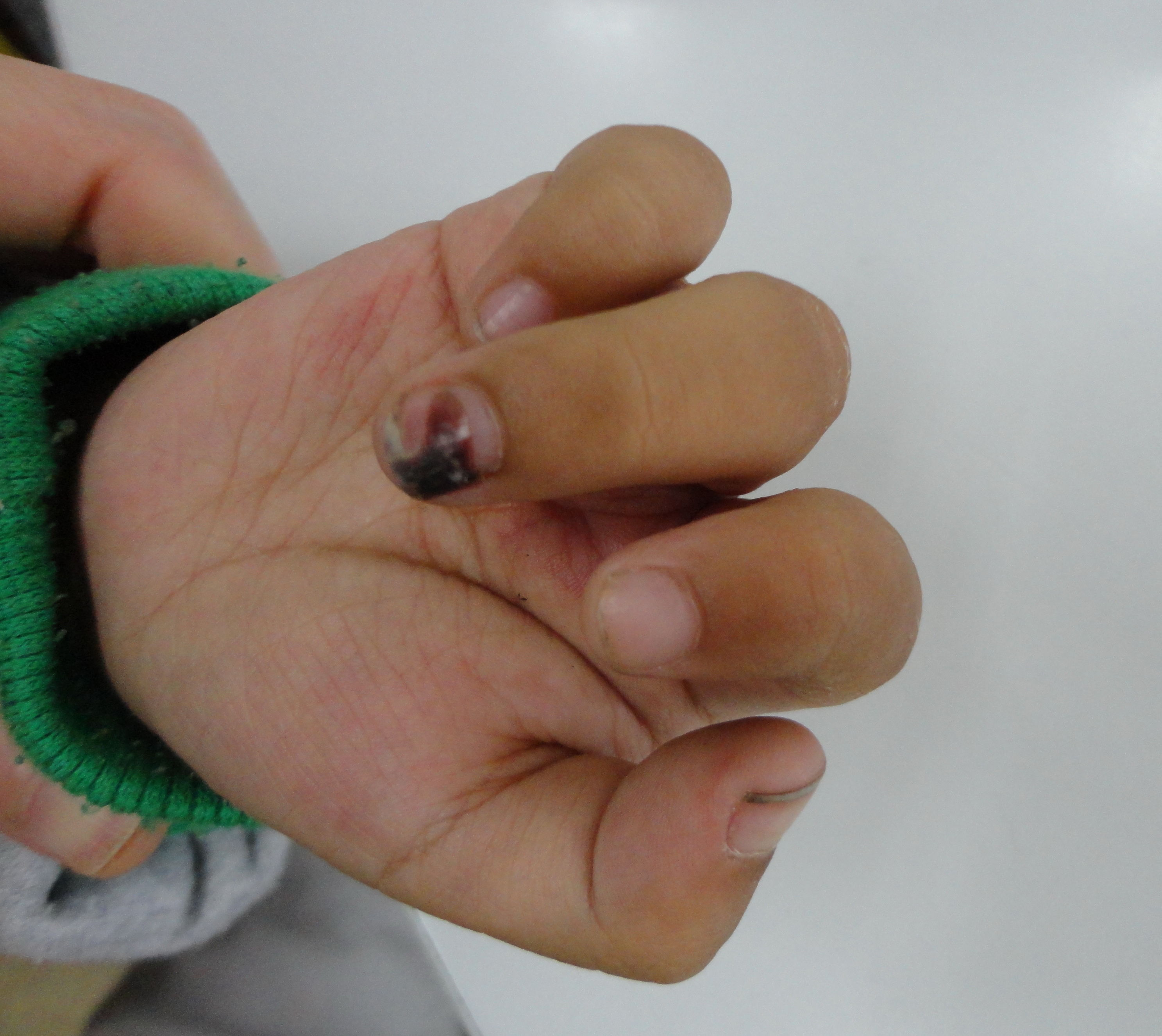 孩子环指指甲是淘气被夹伤了.