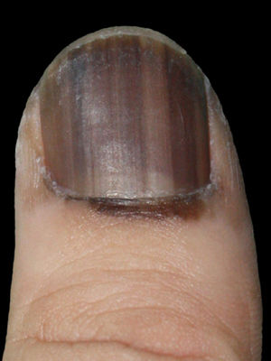 甲黑变甲黑素瘤