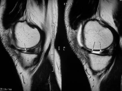 半月板關節囊分離並反轉的mri診斷