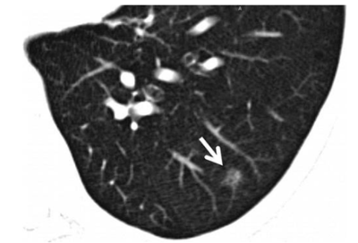 喝什么茶对肺结节有疗效 wYYBAFwR2WmAfjvPAADr7Qg9BK0019.png?_ms_=ace0