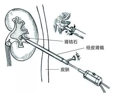 什么叫手术碎石 wYYBAFwR6x6AGFfFAAGysM0rHFo912.png?_ms_=cd51