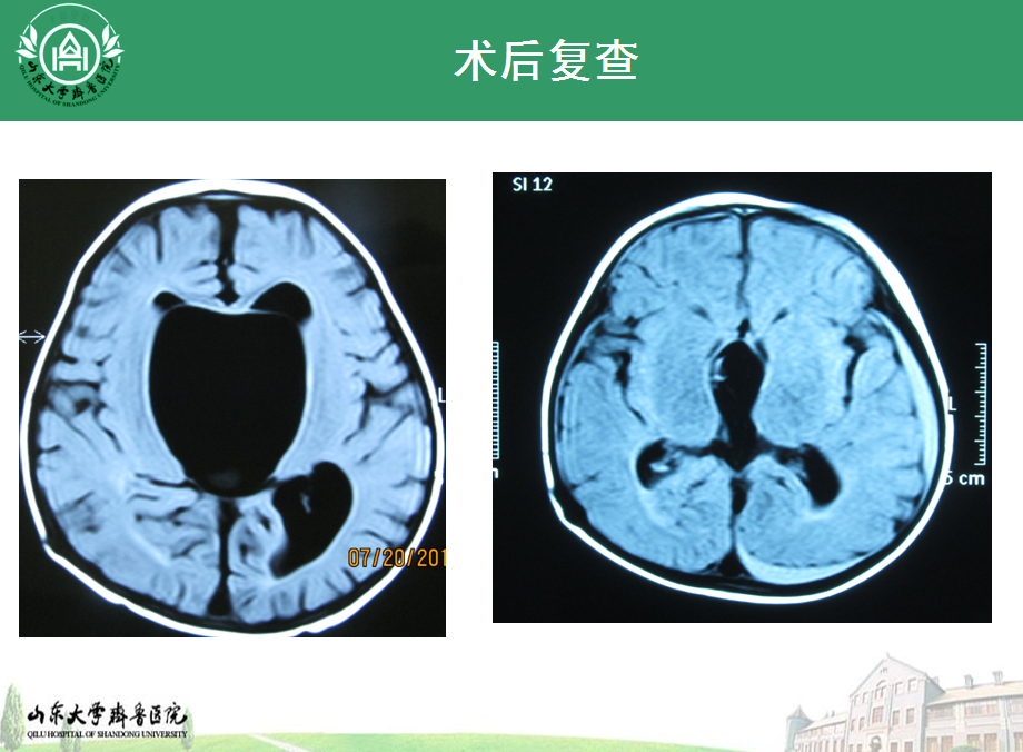 儿童鞍上池蛛网膜囊肿的神经内镜治疗