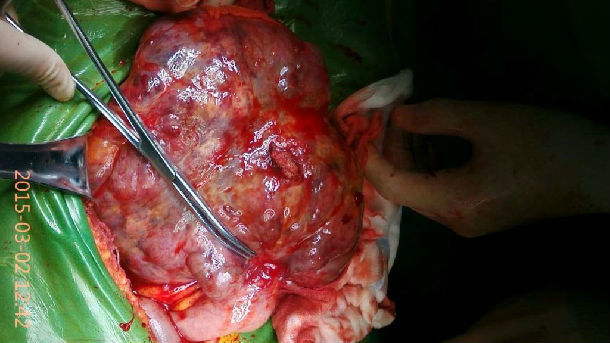 小肠间质瘤图片