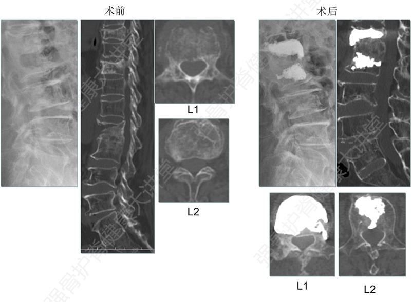 阻滞椎体双骨折,靶向锚定获稳效 - 好大夫在线