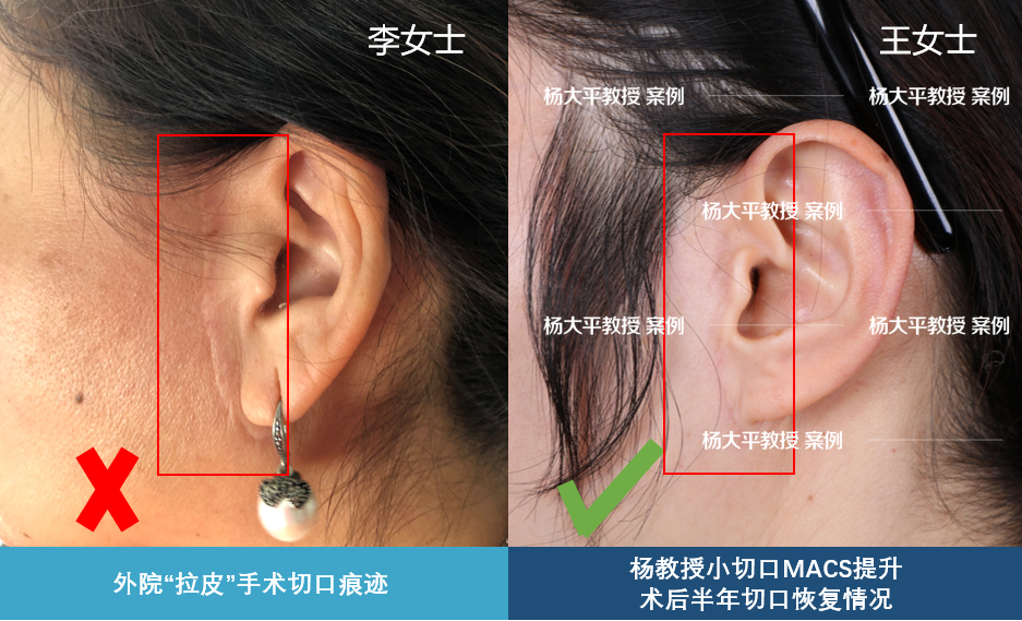 今天一位求美者向我们展示了她多年前在外院进行"拉皮"手术后耳