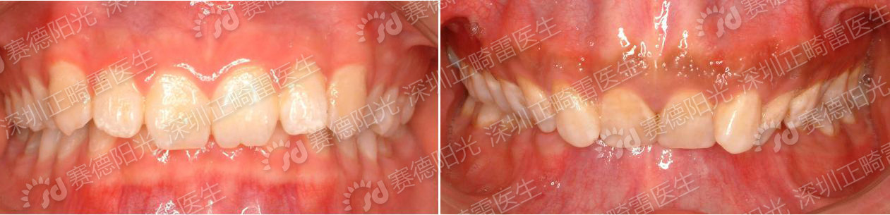 咬合創傷所致牙齦退縮,牙周疾病以及上前牙舌側牙齦經常性破潰