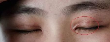 双眼皮最难看的不是菜刀割的肉条,而是闭眼凹陷型疤痕 - 好大夫在线