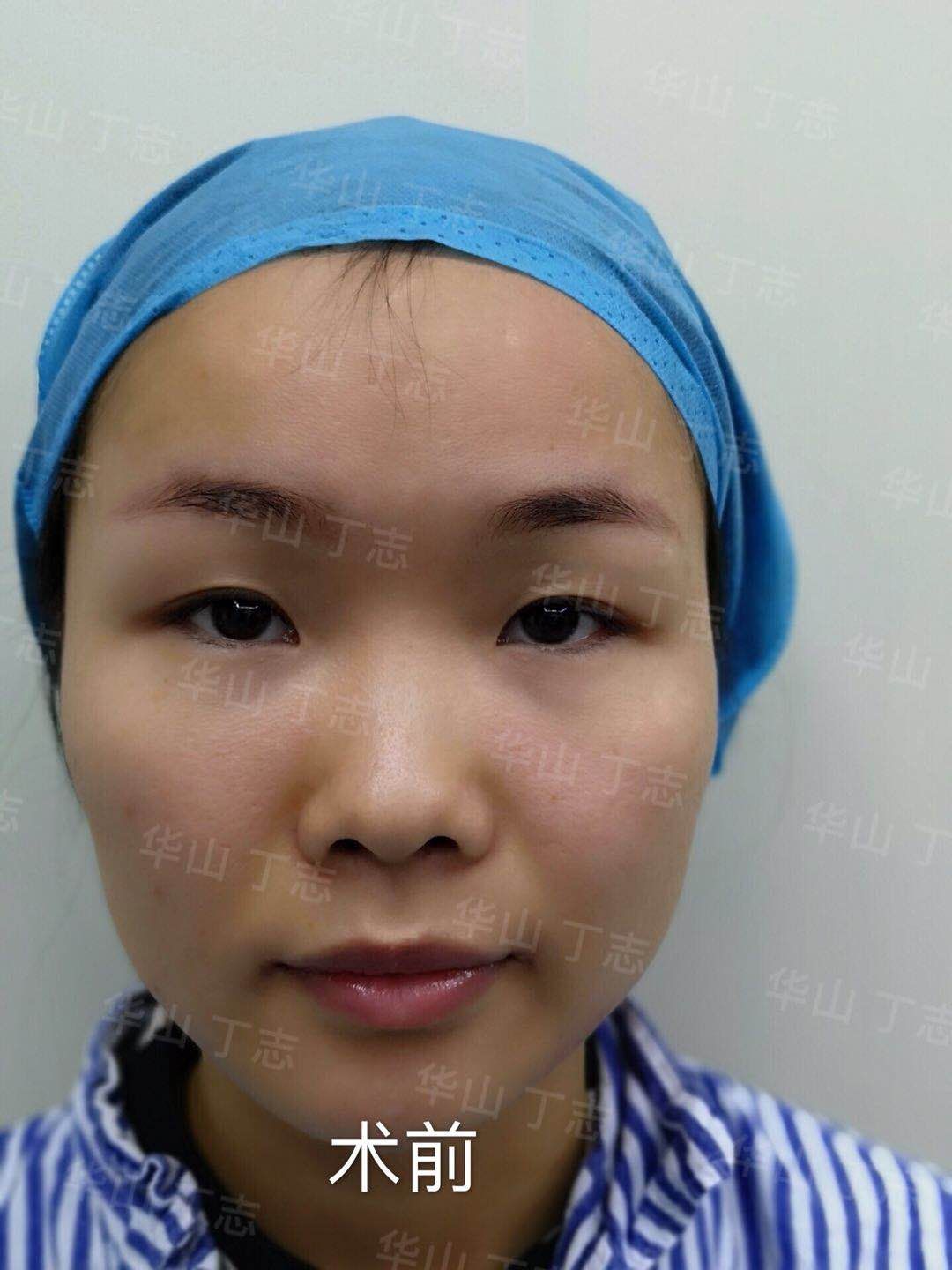 全切双眼皮 内眼角开大(内眦赘皮矫正)术前术后对比 - 好大夫在线