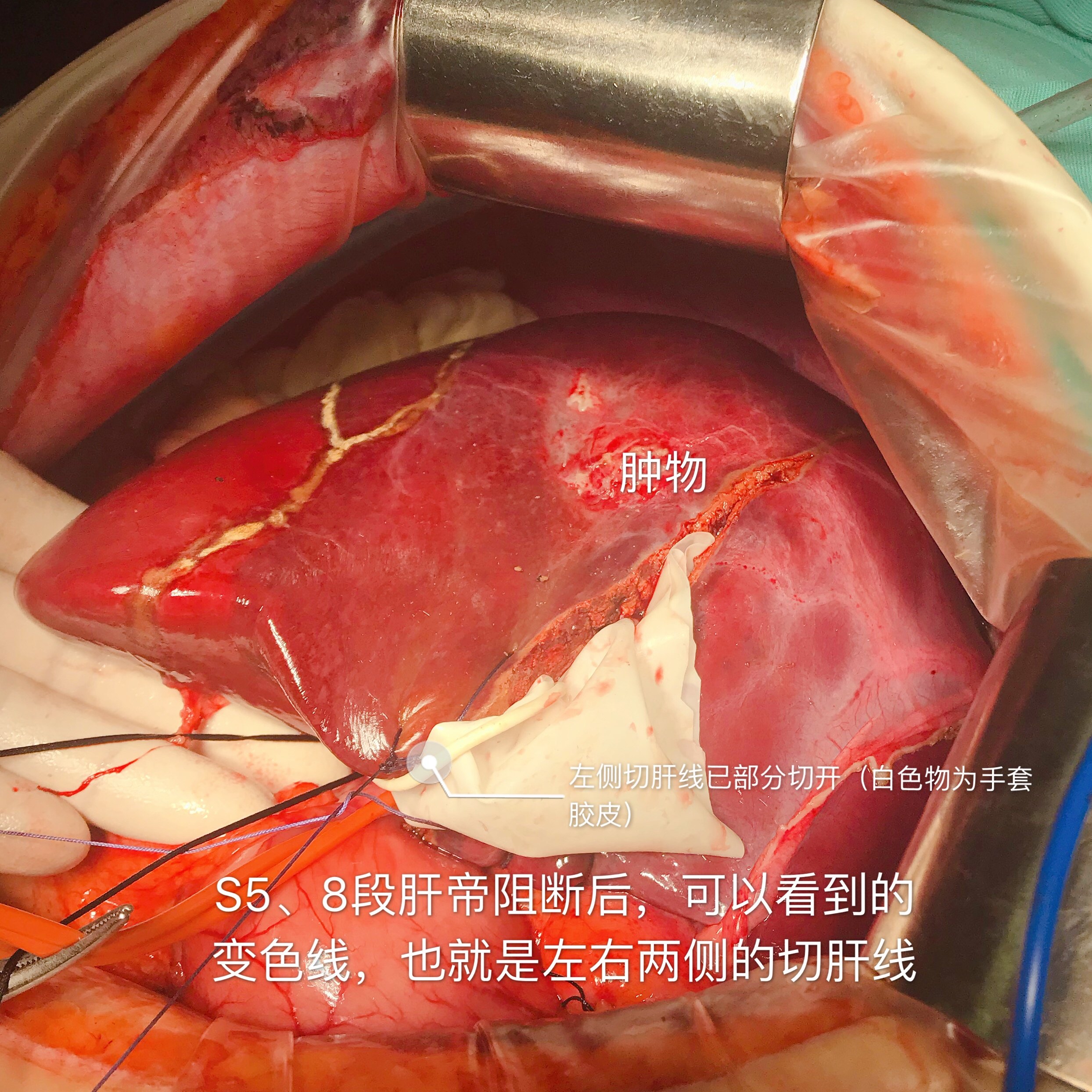 肝脏罕见的良性肿物:炎性假瘤 - 好大夫在线