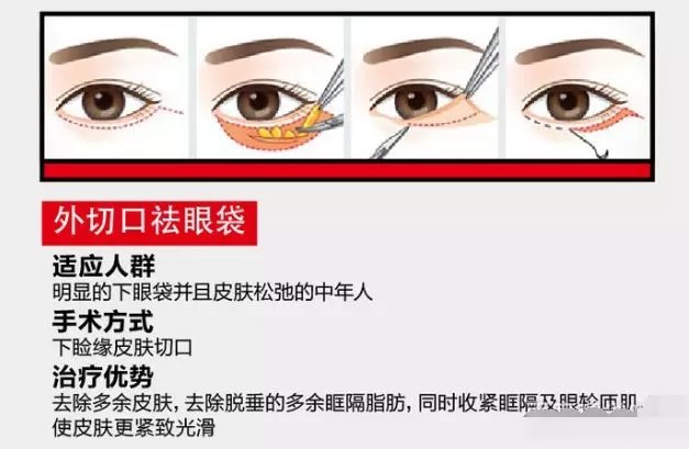 祛眼袋手术——眼部减龄