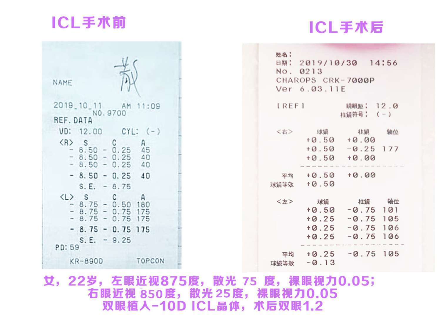 陶勇医生icl手术案例1 陶勇医生icl手术案例1
