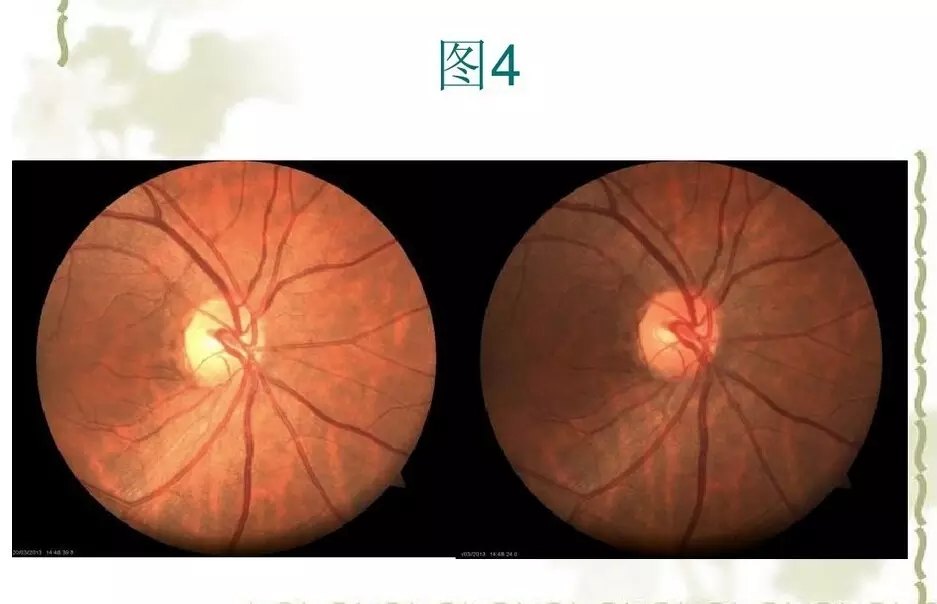 如何拍摄好眼底照片 - 好大夫在线