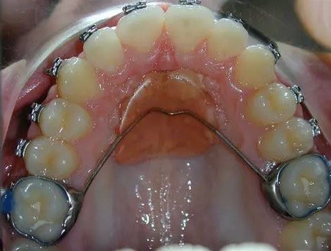 矫正牙齿为什么要打支抗钉