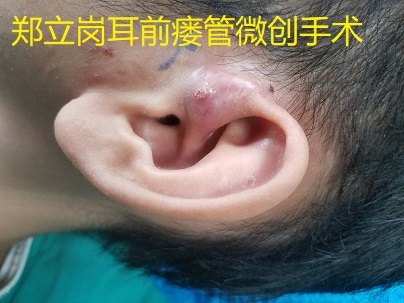 鄭立崗耳前瘻管術後復發微創手術第116廣東茂名信宜麥