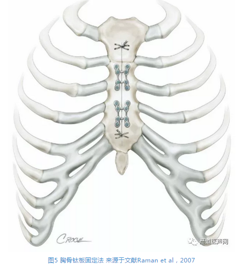 胸骨正中劈开术后如何复位固定胸骨才是最佳的