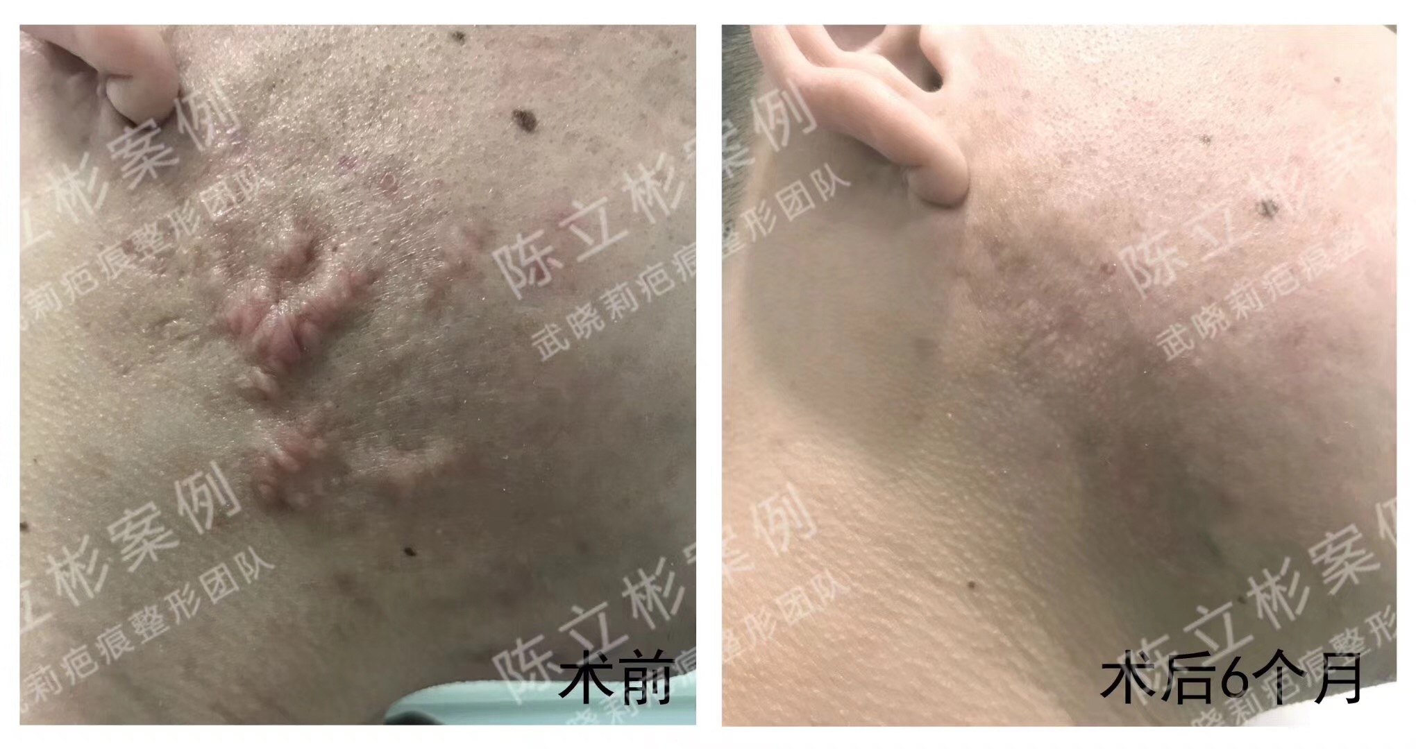 双下颌疤痕疙瘩术后半年复诊
