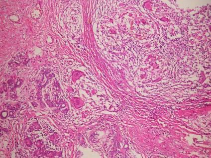 浆细胞乳腺炎 病理图片