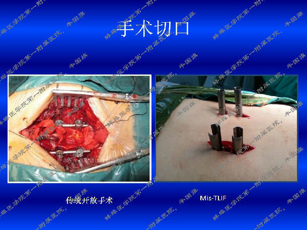 腰椎滑脱症—经皮微创通道下融合术(mis-tlif)之五