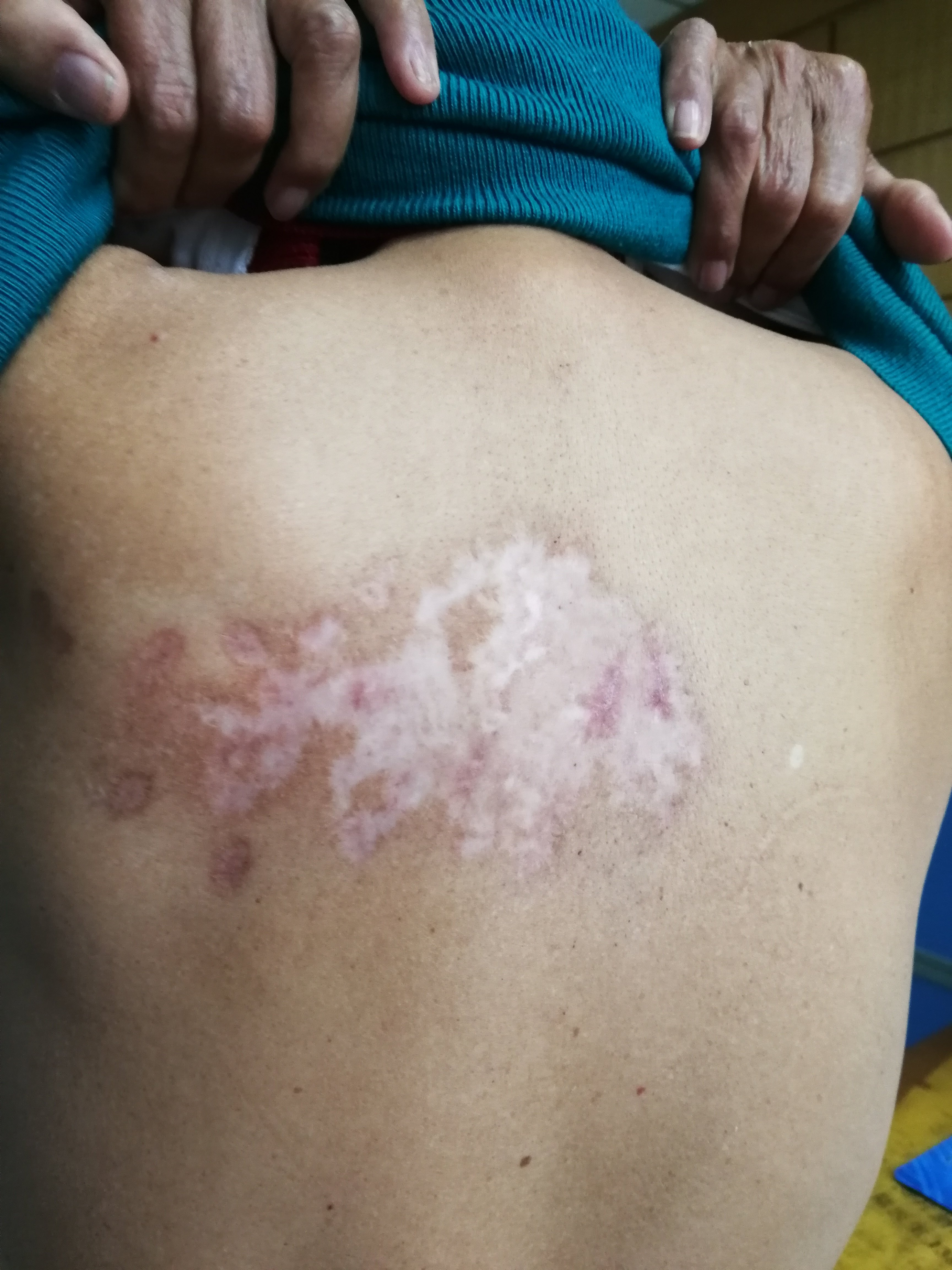 带状疱疹治疗病例 - 好大夫在线