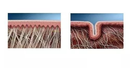 衰老:皮肤屏障受损失去锁水功能,水分持续蒸发,皮肤干燥,真皮层也会