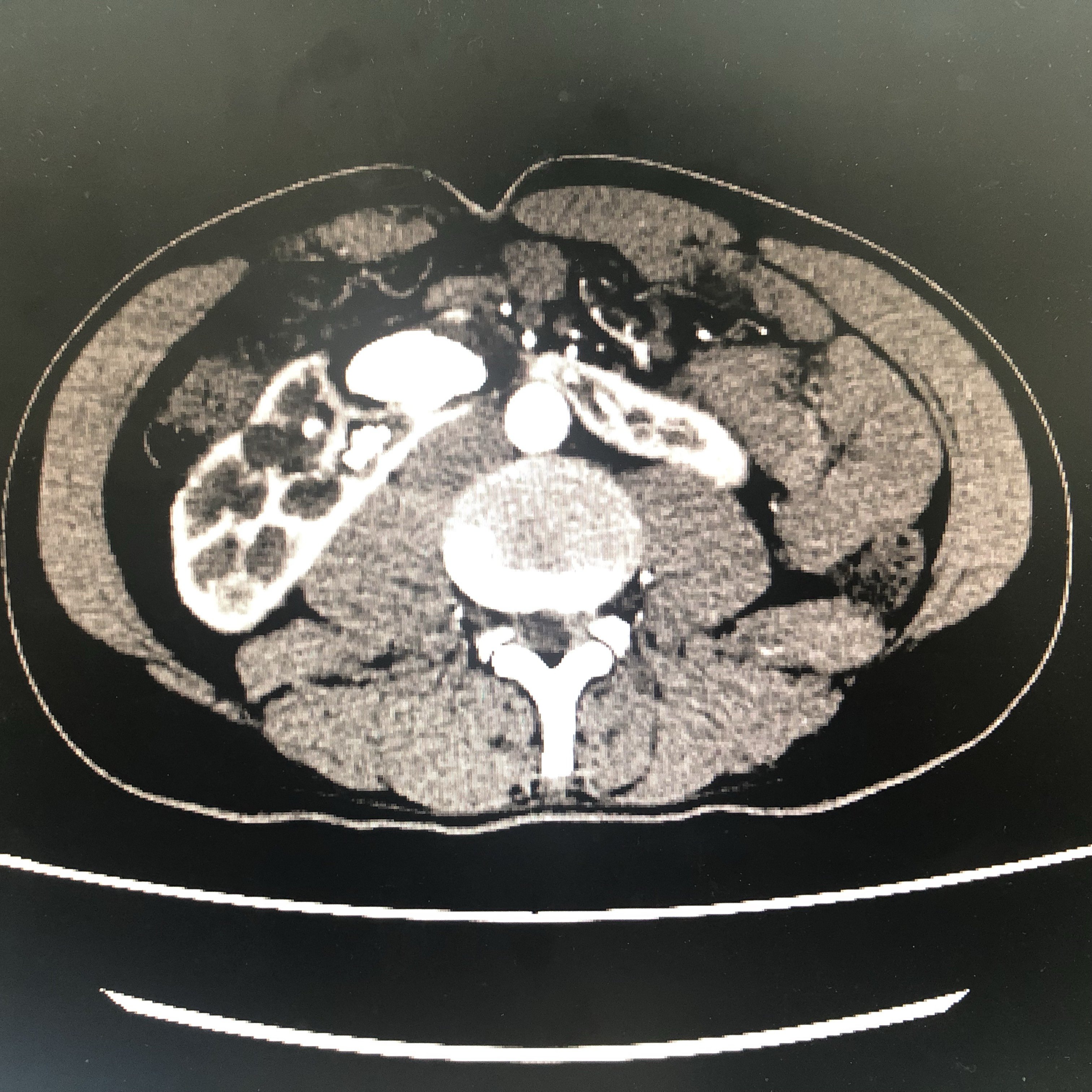 腹腔鏡下馬蹄腎合併鑄型結石手術