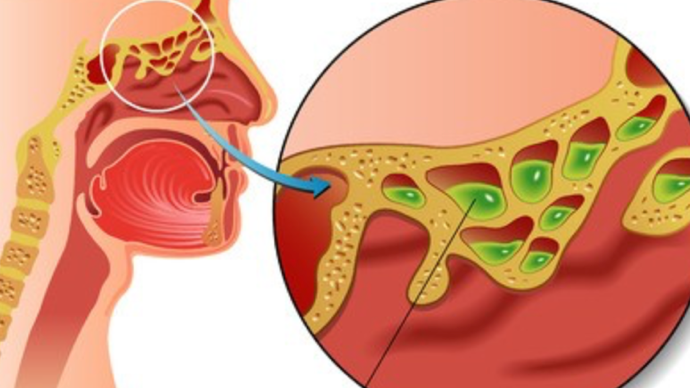 鼻咽癌早期的五大症状图片